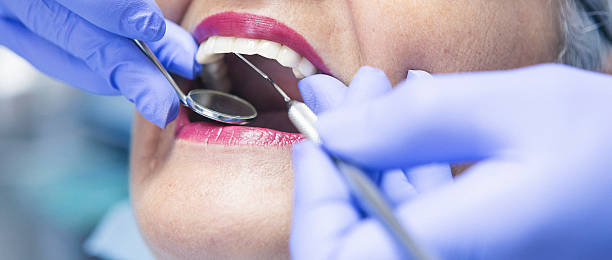 Best Urgent Care for Lost Fillings or Crowns in San Mateo, CA